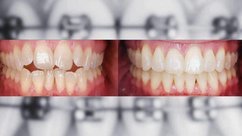 braces as a kid but teeth have shifted ernstbergerortho