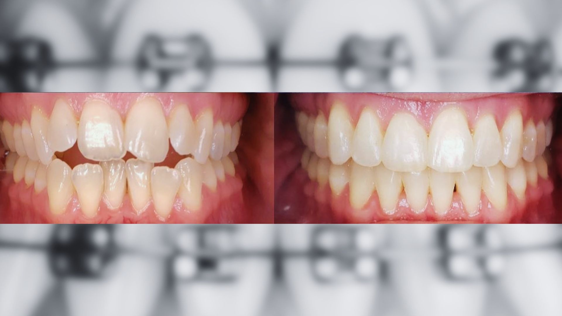 adult orthodontics,teeth shifting,adult braces,orthodontic relapse,braces for adults,teeth shifted after braces